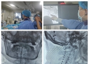 西部首例！脊髓损伤患者脑机接口手术于四川大学华西医院顺利完成