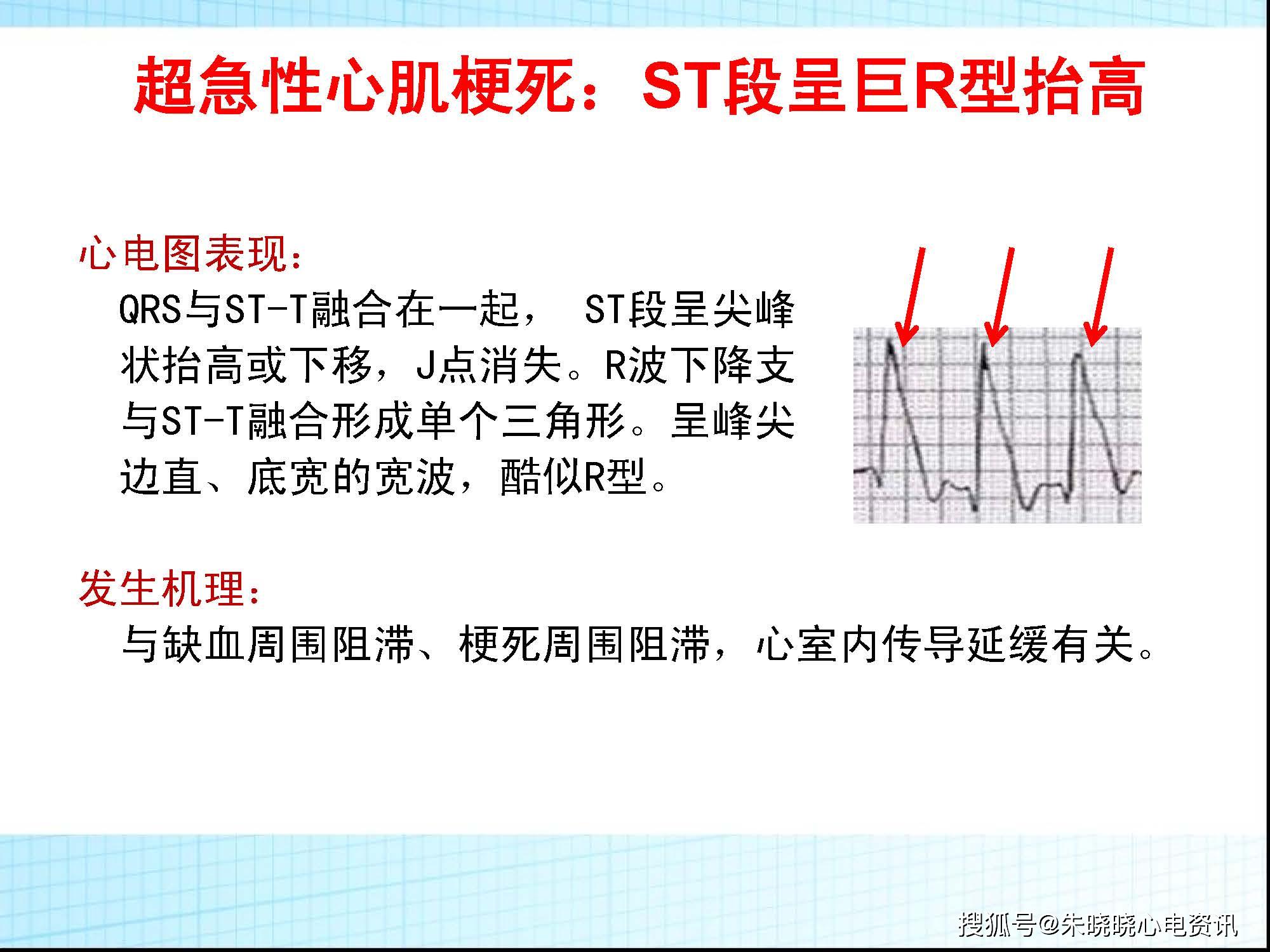 ST凯利获得发明专利授权：“一种多孔结构融合器”