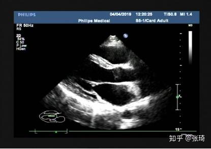 开立医疗获得发明专利授权：“一种标准切面图像替换方法、装置及超声设备和存储介质”